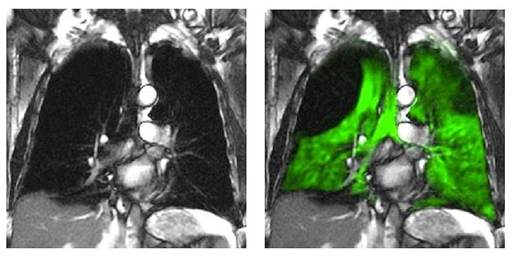 MRI scan of the lungs